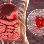 Stomach Ulcers