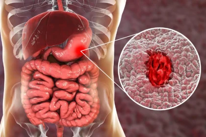 Stomach Ulcers